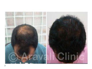 Truehair chuyên sâu duy nhất dịch vụ cấy tóc công nghệ fue micro graft :không rạch, không khâu, không băng bó liên hệ để đặt lịch tư vấn: Hair transplant - Restore Your Crowning Glory