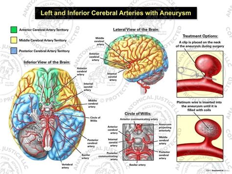 Left And Inferior Cerebral Arteries With Aneurysm