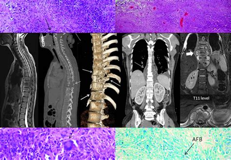 Atypical Imaging Features Of Tuberculous Spondylitis Case Report With