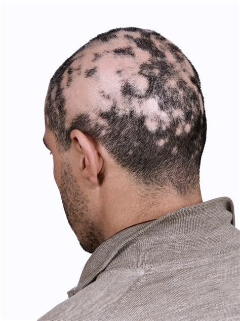 Is Your Hair Loss Normal Or A Case Of Alopecia The Pretty Pimple