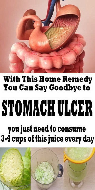 Stomach Ulcers Symptoms And Treatment