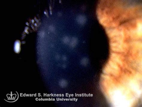 Epidemic Keratoconjunctivitis Vagelos College Of Physicians And Surgeons