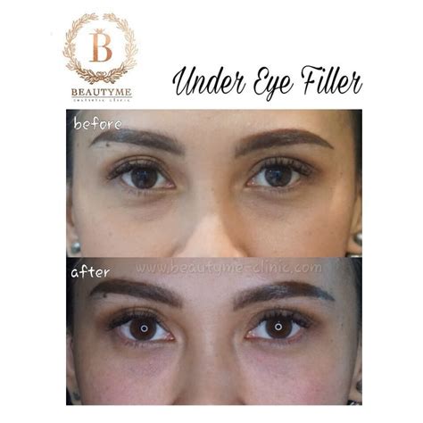 Salah satu jenis cacat mata pada penglihatan manusia yang tampak buram apabila melihat benda yang jauh. Gallery Eye Filler / Under Eye Filler >> Kumpulan Foto Eye ...