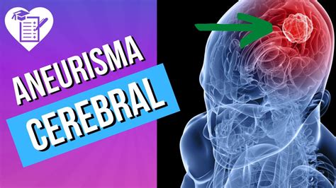 Aneurisma Cerebral Causas Sintomas E Tratamento Youtube