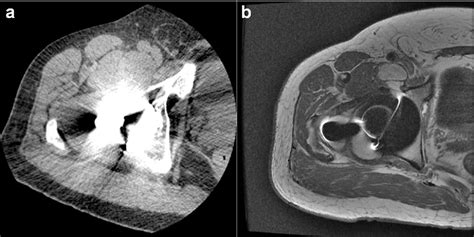 Figure 1 From External Iliac Vein Compression Secondary To Osteolysis