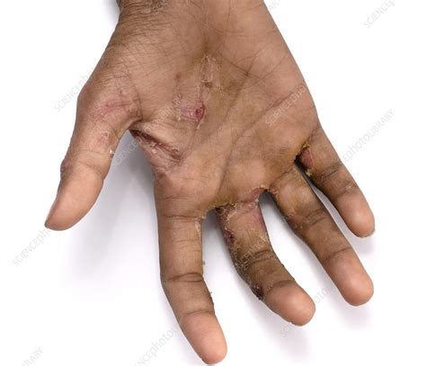 Scabies Infection On The Skin Stock Image C0528184 Science Photo