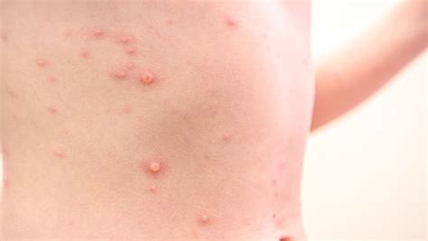 How To Treat Common Skin Infections Treatment Sparsh Skin Clinic