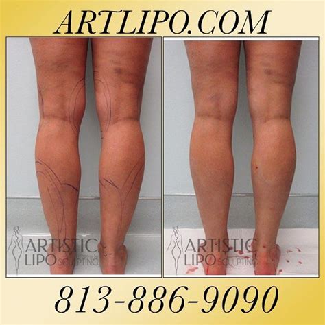 Cankles Ankles Calves And Knees Are Areas That Many Women Arent Aware That Liposuction