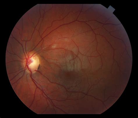 Moran Core Fundus Photography And Fluorescein Angiography Of Susacs