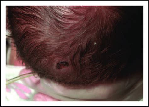 Discrete Crusted Ulceration On The Scalp Of An Infant Resulting From