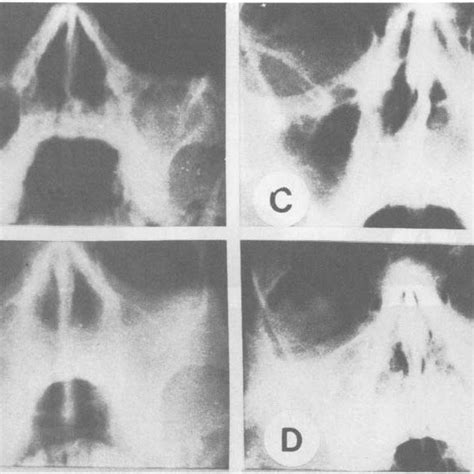 Radiographic Signs Of Chronic Maxillary Sinusitis On Waters View