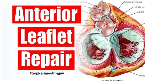 How Anterior Leaflet Repair For Your Heart Works