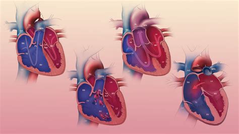 Congenital Heart Defects Diagrams