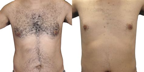 Hair Removal Vein And Laser Institute