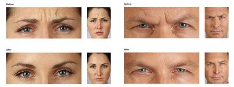 Muscle tension in the face. Botox Cosmetic Chicago IL