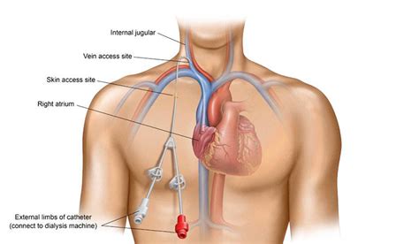 5 Central Venous Catheter Cvc Complications