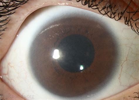 Corneal Clouding In Hurlers Syndrome