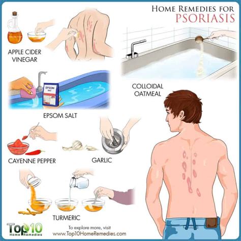 Psoriasis Home Remedies For Relief And When To See A Doctor Top 10 Home Remedies