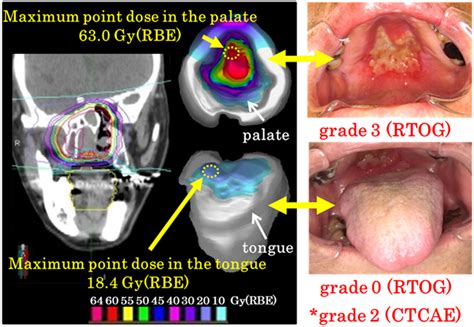 Oral Mucosal Dose Surface Model And Corresponding Download