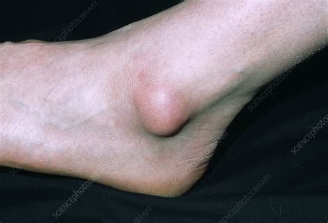 Bursa On Ankle Stock Image M1200127 Science Photo Library