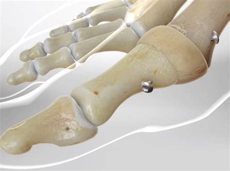 Video Big Toe Fusion First Metatarsal Phalangeal Joint Arthrodesis Healthclips Online