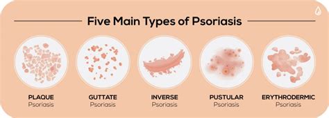 Psoriasis Types Telegraph