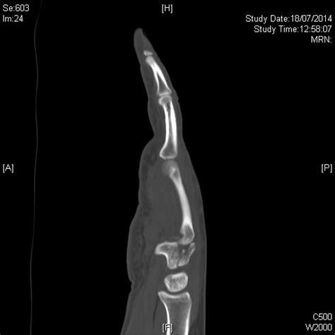 Hamate Body Fracture Hand Orthobullets