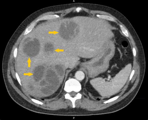 Liver Abscess Ct Scan Stock Image C0267955 Science Photo Library Images