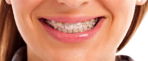 Softer foods can help reduce pain and irritation. Discomfort From Getting Braces Tightened | Frost Orthodontist