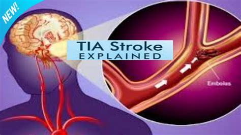 Transient Ischemic Attack Tia A To Z Informations Health Physician