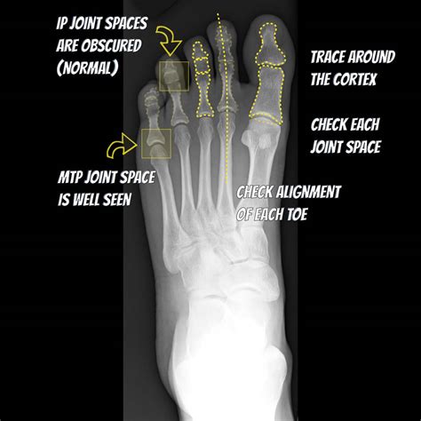 Submitted on march 27, 2012. Foot radiograph (an approach) | Radiology Reference ...