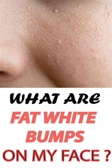What Are White Fat Bumps On My Face Healthylife