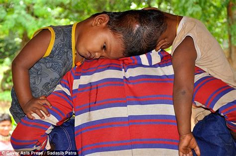 Indian Couple Dream Of Surgery For Their Conjoined Twins Daily Mail Online