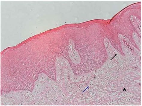 Photomicrograph Of Histological Findings Of Gingival Hyperplasia