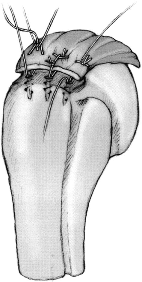 A Modified Mason Allen Technique For Rotator Cuff Repair Using Suture