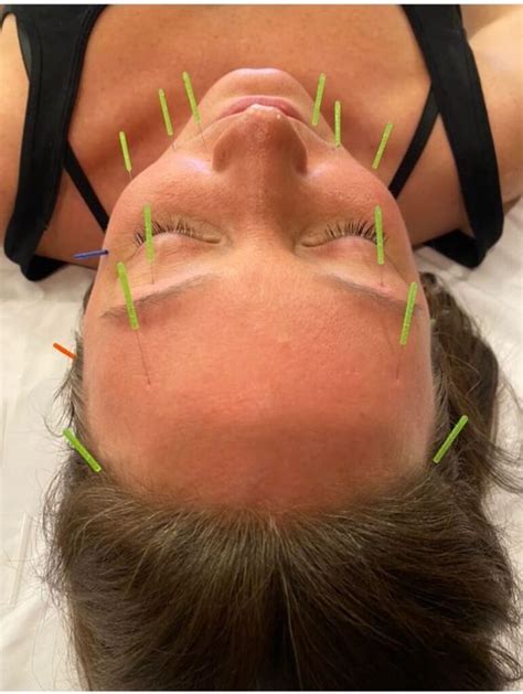 The Magic Of Acupuncture Can It Treat Bells Palsy Art Of Healing