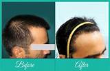 Alopecia Doctor Pictures