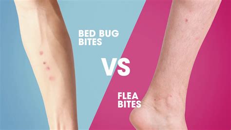 Essbar Routine Beruhigen Difference Between Flea And Bed Bug Bites