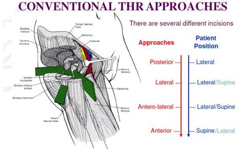 Total Hip Replacement Posterior Approach
