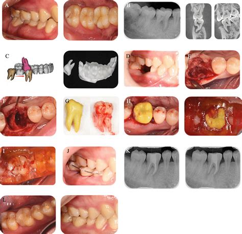 A Buccal And Occlusal Initial Situations Of The Recipient Site B