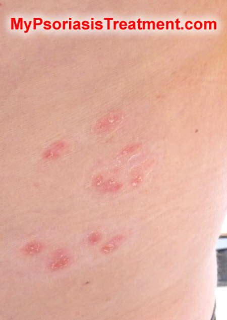 Webmd Psoriasis Vs Eczema Dorothee Padraig South West Skin Health Care