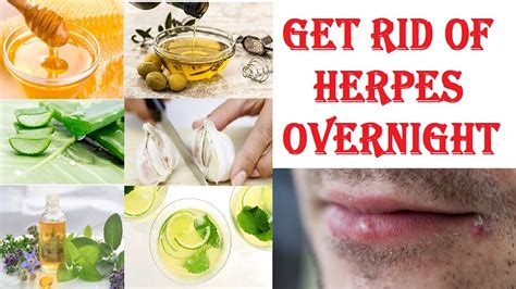 how to cure herpes overnight natural home remedies for removal of herpes youtube