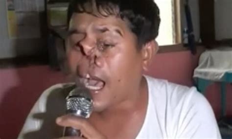 Man Born With A Deformed Face Demonstrates Impressive Singing Voice