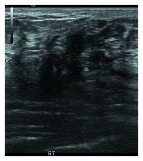 The Ultrasound Examination Demonstrated A Solid Hypoechoic Mass With An