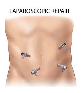 Hernia Surgery California Hernia Specialists