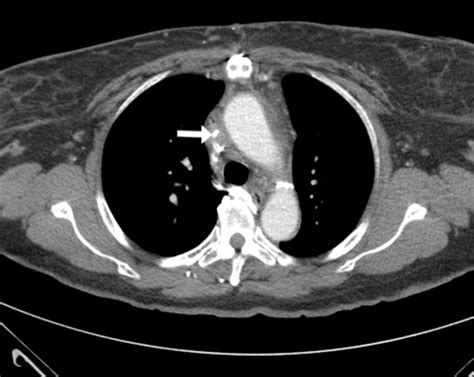 Ct Scan With Contrast Of The Chest Shows Narrowing Of T