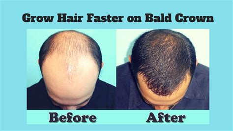 10 How To Grow Hair Faster On Bald Patches