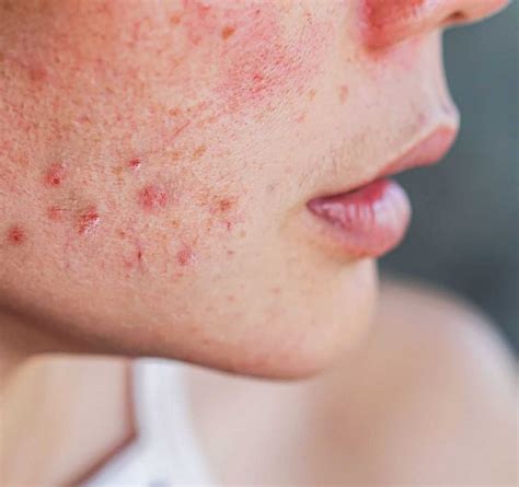 The Ultimate Guide Which Pimples Should You Pop For Clear And Glowing