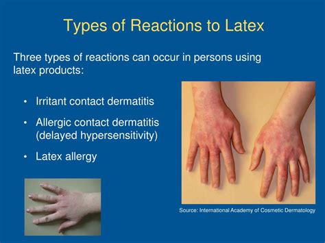 Hand Allergic Reaction To Latex Gloves Images Gloves And Descriptions