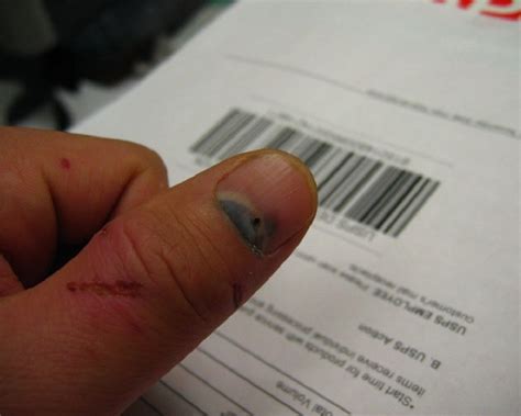 Dark Spot On Fingernail Reasons For Dark Spots On Fingernails